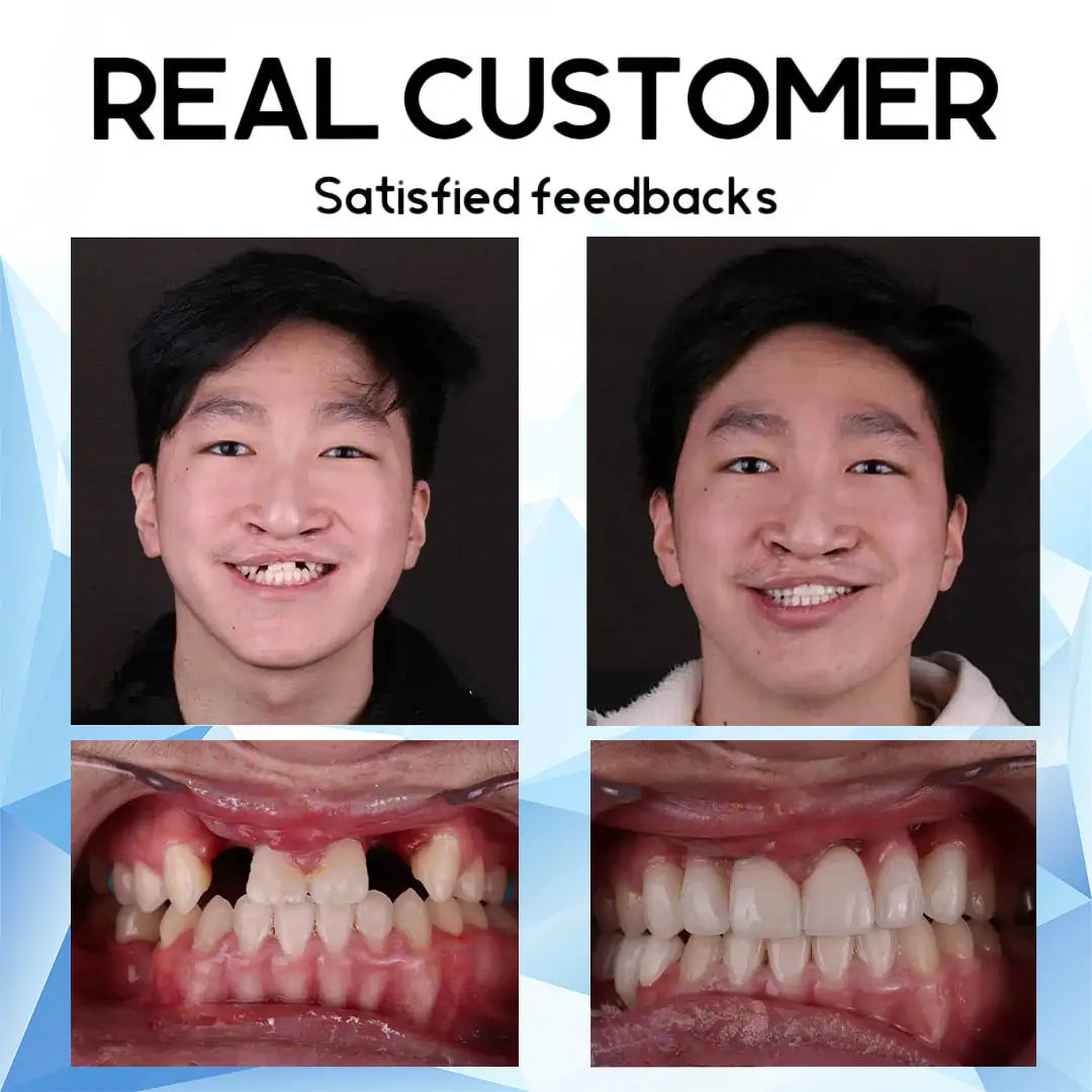 SmilePro™ – Hochwertiges, individuell angepasstes Silikon-Prothesenset