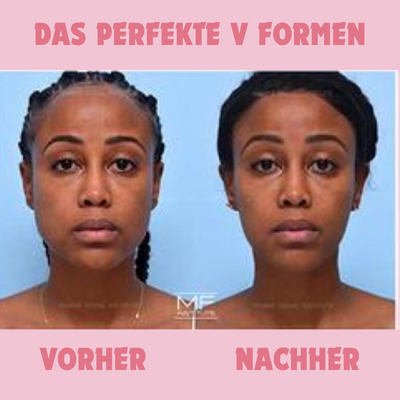 GesichtForm™ Defining Jawline Optimization