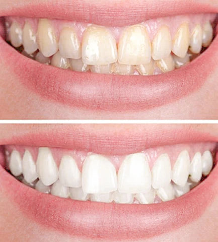 Gel blanchissant pour dents pour éliminer les taches | Doux pour les dents sensibles | Haleine fraîche et sensation de bouche propre | Temps d’application 8–10 min