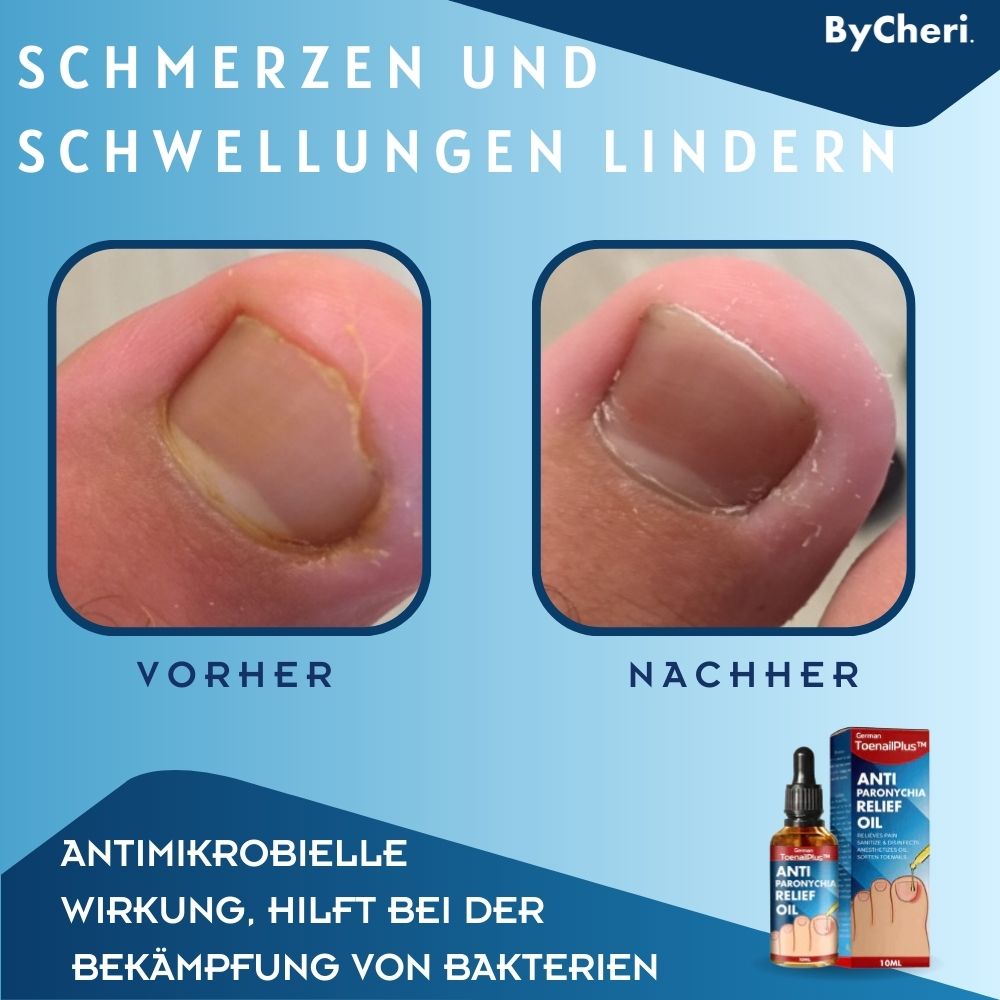 Olio per la cura delle unghie con bordo ungueale irritato | Con olio di chiodi di garofano, vitamina E e burro di karité | 10 ml