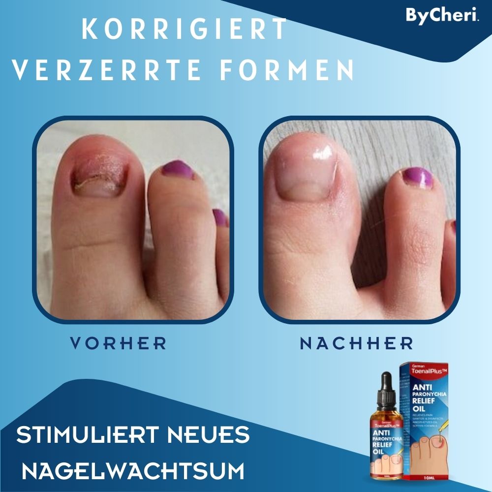Olio per la cura delle unghie con bordo ungueale irritato | Con olio di chiodi di garofano, vitamina E e burro di karité | 10 ml
