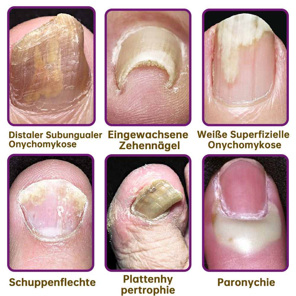 1+1 FREE | MushroomShield™ Eliminates nail fungus