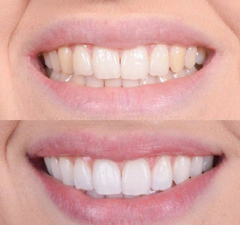 Gel blanchissant pour dents pour éliminer les taches | Doux pour les dents sensibles | Haleine fraîche et sensation de bouche propre | Temps d’application 8–10 min