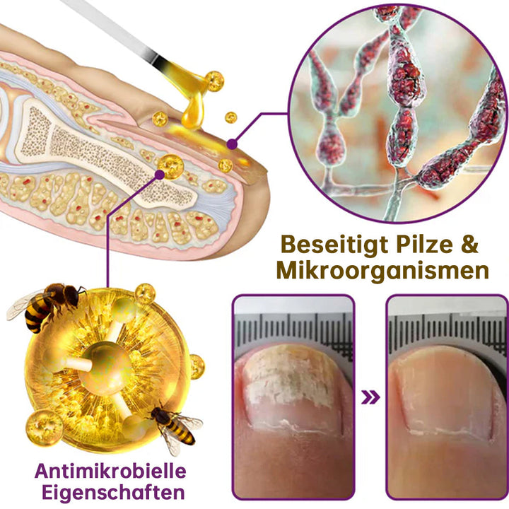 1+1 FREE | MushroomShield™ Eliminates nail fungus