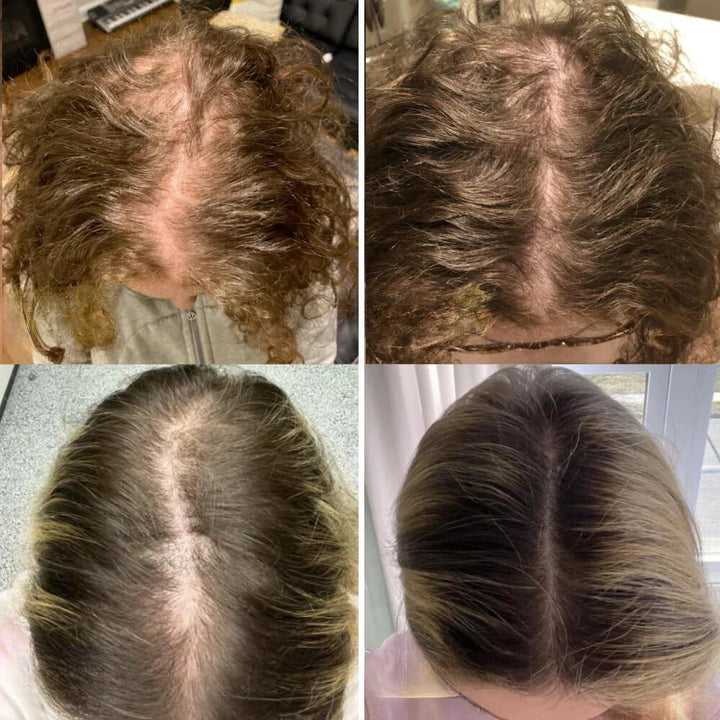Natürliches Haarwuchs-Öl gegen Haarausfall &amp; Haarbruch | Pflege für dichteres, stärkeres Haar | Kopfhaut Serum für Frauen &amp; Männer