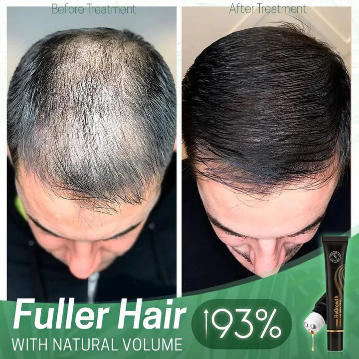 Haarserum mit Massage-Roller für Kopfhaut – pflanzliche Kräuterextrakte | 20 ml Roll-on, präzise Dosierung | Für Glanz &amp; Fülle