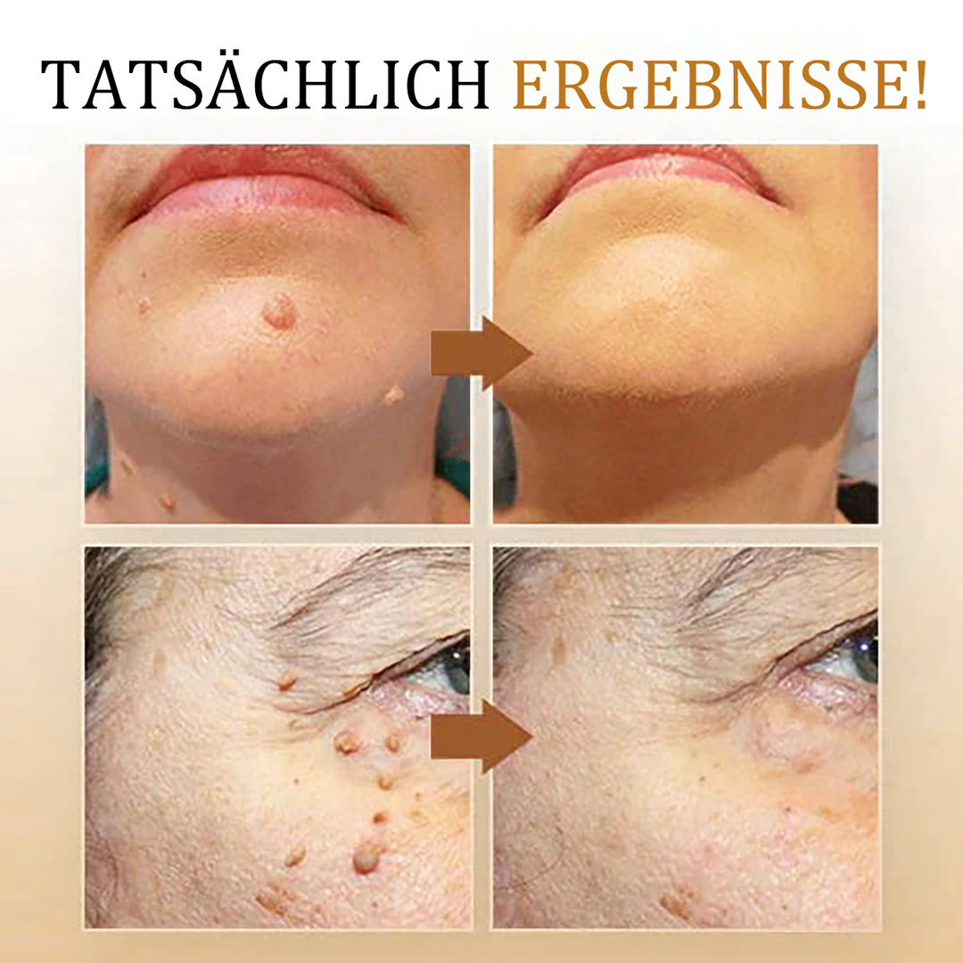 1+1 gratis | Skin Free™ l Tutte le macchie, nei e verruche vengono eliminate al 90% entro 3 giorni!