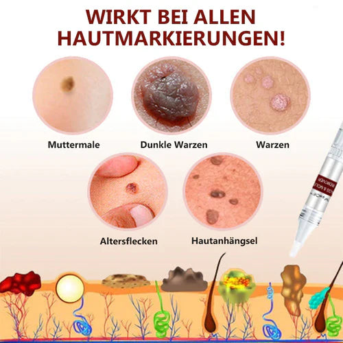 Hautanhängsel Entferner | Präzise Punkt-Anwendung | Glatter wirkende Haut | Für Hals, Achsel &amp; weitere Problemzonen