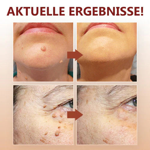 Hautanhängsel Entferner | Präzise Punkt-Anwendung | Glatter wirkende Haut | Für Hals, Achsel &amp; weitere Problemzonen