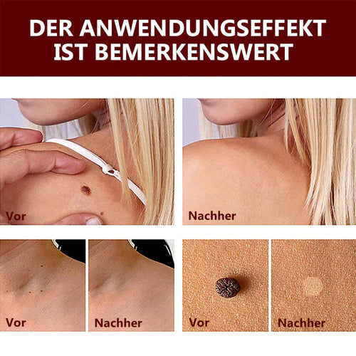 Hautanhängsel Entferner | Präzise Punkt-Anwendung | Glatter wirkende Haut | Für Hals, Achsel &amp; weitere Problemzonen