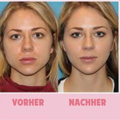 GesichtForm™ Defining Jawline Optimization