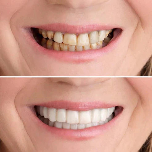 Set de facettes dentaires clipsables malléables | Sourire plus blanc instantané en quelques secondes | Réutilisable et doux pour les dents | 1 set en blanc
