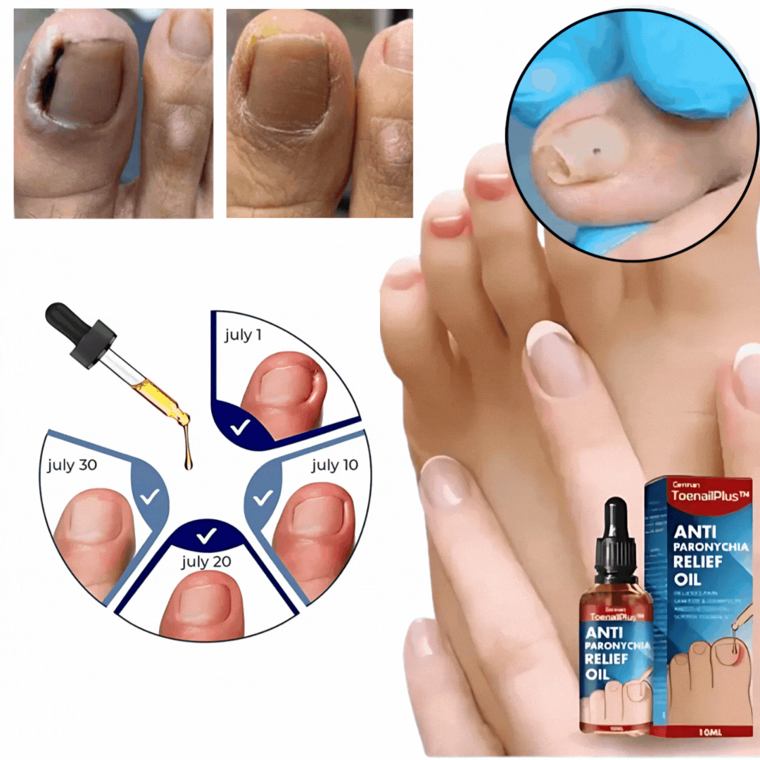 Olio per la cura delle unghie con bordo ungueale irritato | Con olio di chiodi di garofano, vitamina E e burro di karité | 10 ml