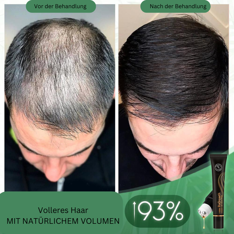 Bio vlasové sérum v rolleri na pokožku hlavy | S bylinnými extraktmi, nezanecháva mastný pocit | Jednoduchá aplikácia a vmasírovanie | 20 ml (1+1 sada)