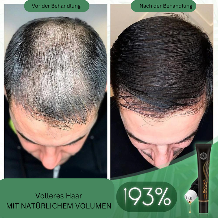 Bio vlasové sérum v rolleri na pokožku hlavy | S bylinnými extraktmi, nezanecháva mastný pocit | Jednoduchá aplikácia a vmasírovanie | 20 ml (1+1 sada)