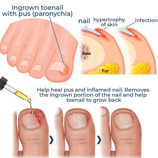 ToenailPlus™ Oil for relieving paronychia