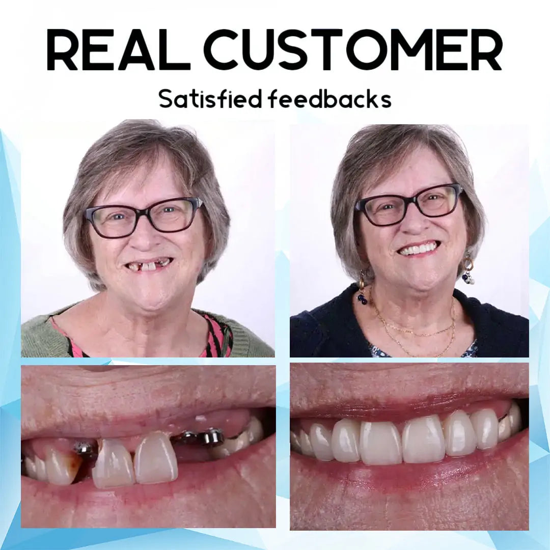 SmilePro™ – Hochwertiges, individuell angepasstes Silikon-Prothesenset